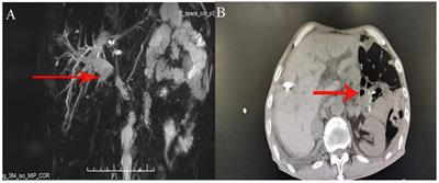 PTCD and choledochoscopy for recurrent choledocholithiasis after multiple abdominal surgeries: a case report